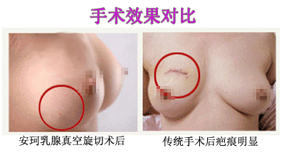 安珂手术效果对比图