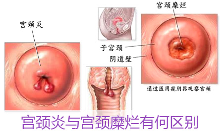 宫颈炎与宫颈糜烂有何区别