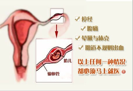 宫外孕症状