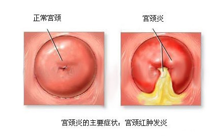 什么是宫颈炎